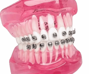 Medical Dental orthodontic braces.